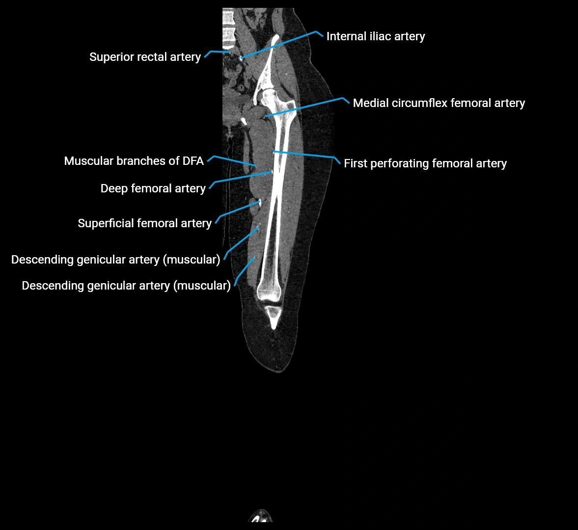 CTA lower limb coronal cross sectional anatomy labelled image _36 (2).webp